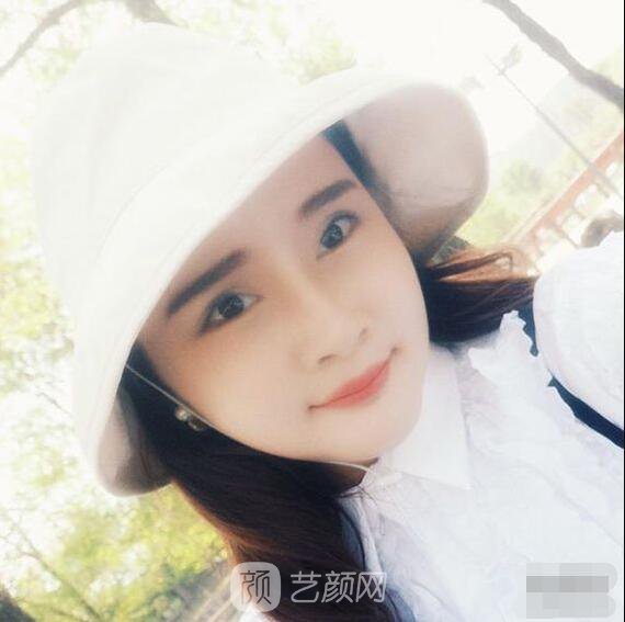 顴骨內(nèi)推真實(shí)案例，小臉網(wǎng)紅模板臉型