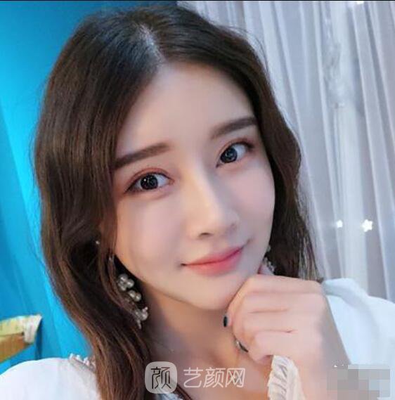 顴骨內(nèi)推真實(shí)案例，小臉網(wǎng)紅模板臉型