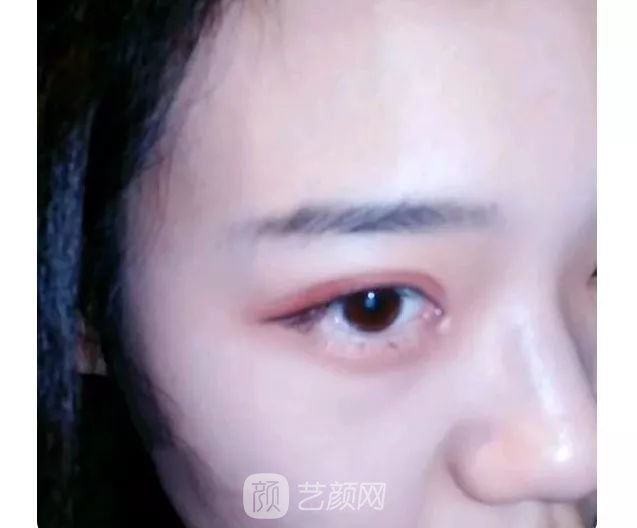 脂美人雙眼皮手術(shù)大公開(kāi)！我終于整容了！
