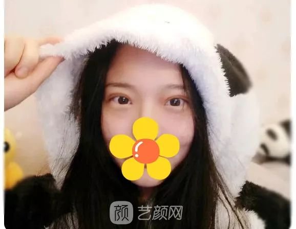 脂美人雙眼皮手術(shù)大公開(kāi)！我終于整容了！