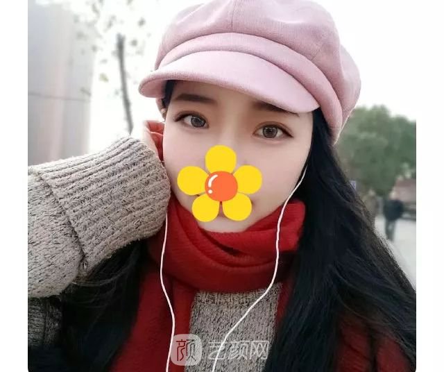 脂美人雙眼皮手術(shù)大公開(kāi)！我終于整容了！