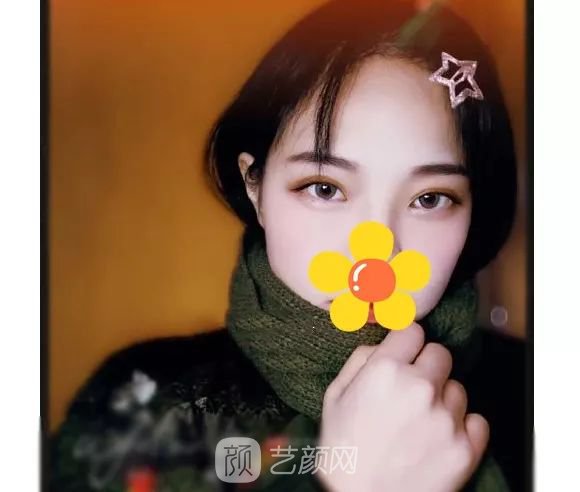 脂美人雙眼皮手術(shù)大公開(kāi)！我終于整容了！