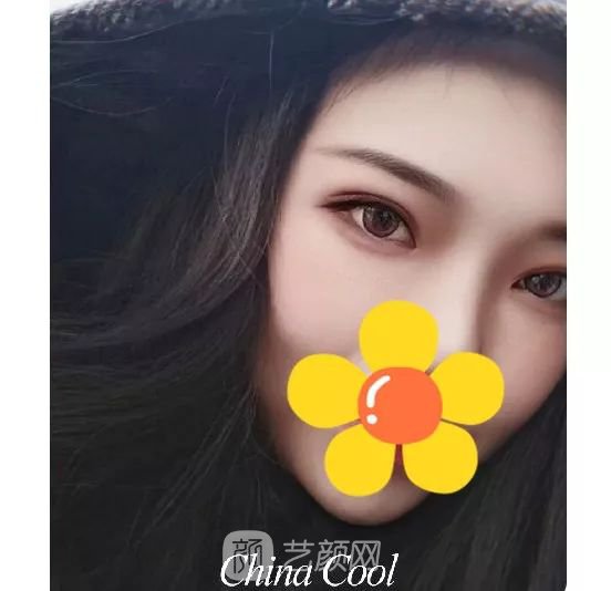 脂美人雙眼皮手術(shù)大公開(kāi)！我終于整容了！