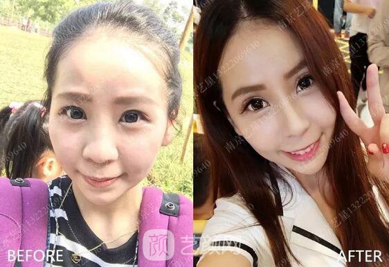 只需要5分鐘，我的鼻子變高了！——南京藝星玻尿酸隆鼻~