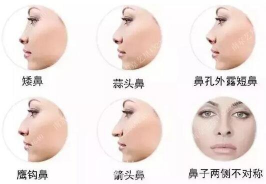 只需要5分鐘，我的鼻子變高了！——南京藝星玻尿酸隆鼻~
