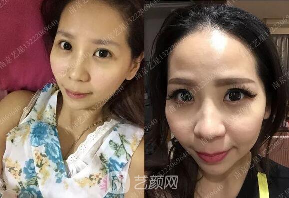 只需要5分鐘，我的鼻子變高了！——南京藝星玻尿酸隆鼻~