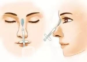 只需要5分鐘，我的鼻子變高了！——南京藝星玻尿酸隆鼻~
