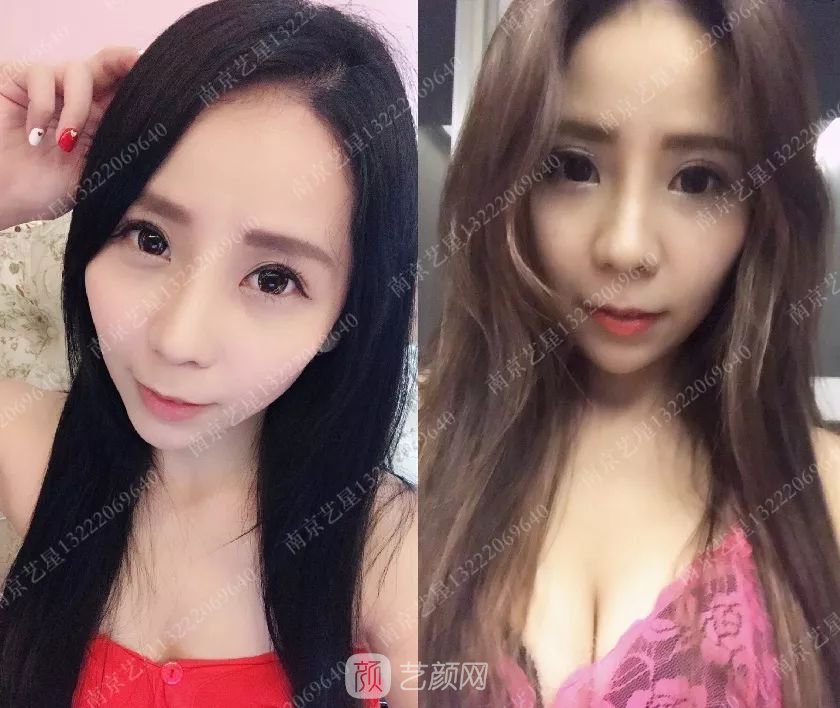 只需要5分鐘，我的鼻子變高了！——南京藝星玻尿酸隆鼻~