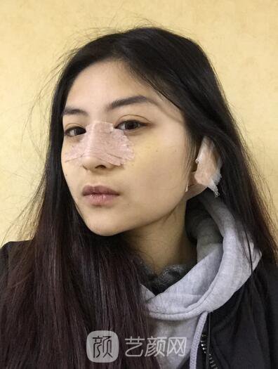 割雙眼皮案例