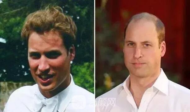 徐崢回應脫發(fā)、英國小刺猬因壓力大脫毛！不得不說“禿”真是不分界的...