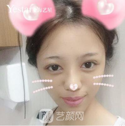上海藝星切開雙眼皮案例，論雙眼皮的重要性