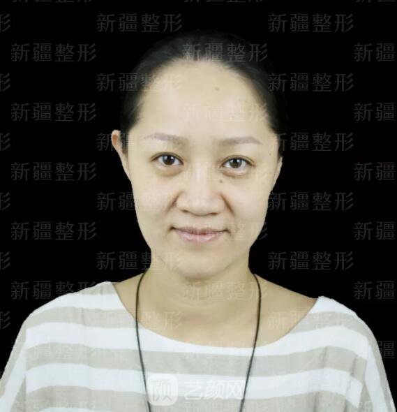 埋線提升提拉只是下垂的皮膚？不，更是我逝去的年華~