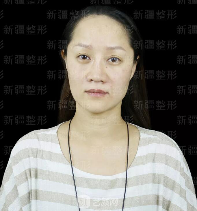 埋線提升提拉只是下垂的皮膚？不，更是我逝去的年華~