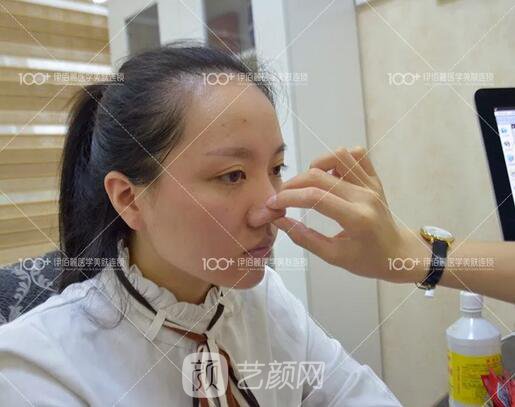 耳軟骨隆鼻術(shù)后一個(gè)月的果，真實(shí)日記一則給大家看看~