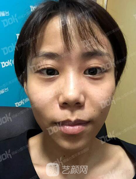 內(nèi)切祛眼袋果怎么樣？來瞧瞧這些照片就可能會有答案了哦~