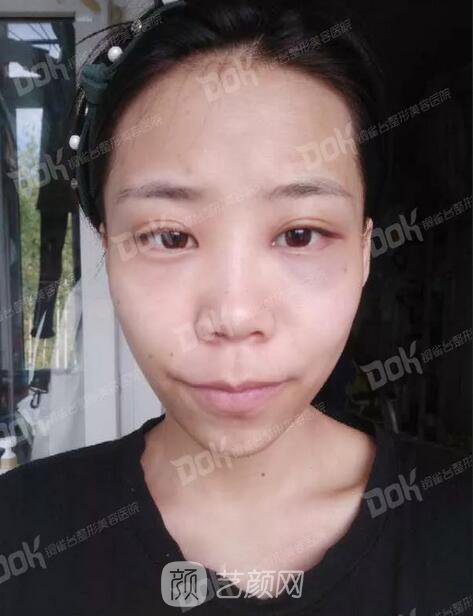 內(nèi)切祛眼袋果怎么樣？來瞧瞧這些照片就可能會有答案了哦~