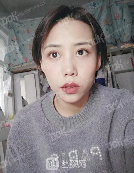 內(nèi)切祛眼袋果怎么樣？來瞧瞧這些照片就可能會有答案了哦~