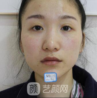 韓式翹鼻-真人案例，直呼我是混血兒