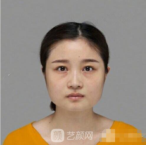 揚(yáng)州郭軍下頜角案例，通過下頜角整形大臉變成瓜子臉