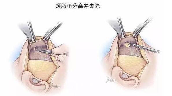 去八大處去頰脂墊價(jià)格多少