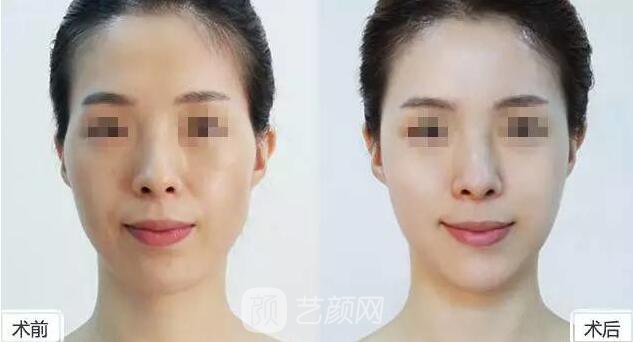 做了全臉脂肪移植+磨骨等一系列手術 現(xiàn)在美翻了