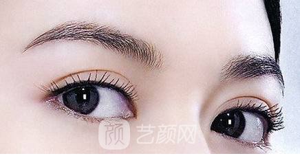 雙眼皮兩個(gè)月，是這個(gè)樣子的，大家來(lái)看看