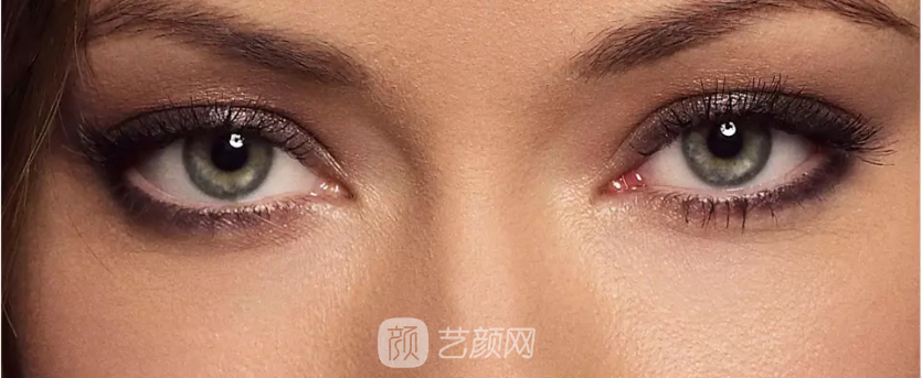 雙眼皮手術類型太多，怎么選擇?
