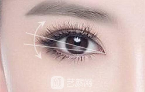 張掖顏藝美整形埋線雙眼皮怎么樣?