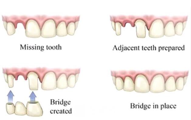 做容冠，牙齒整齊又漂亮~