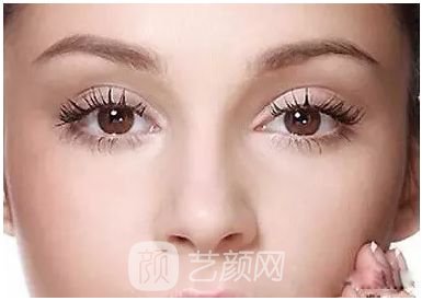 做完雙眼皮兩個月，簡直跟換了個人似的