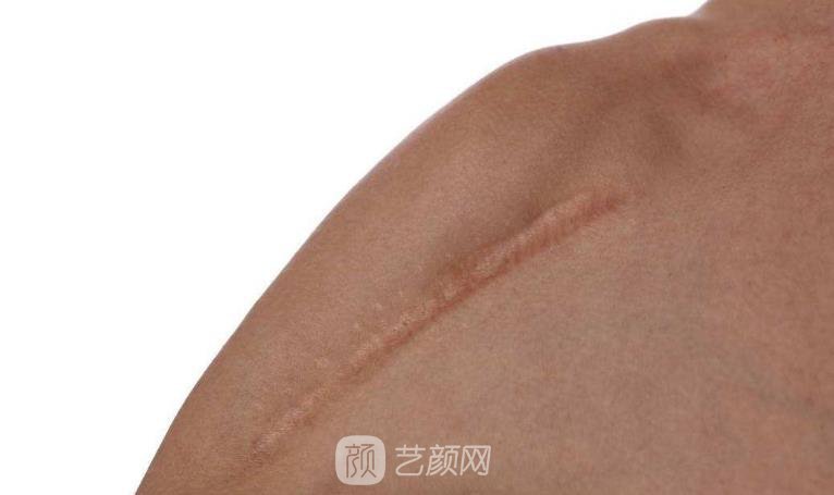 杭州激光去疤費用，多久見