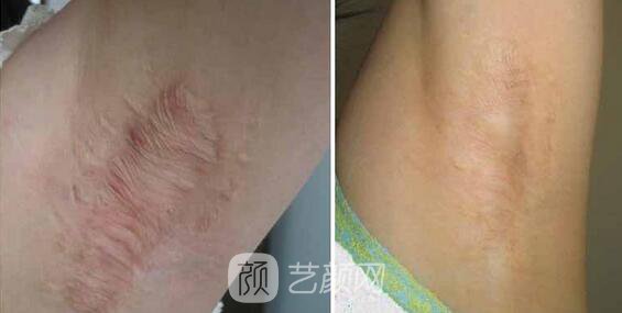 杭州激光去疤費用，多久見