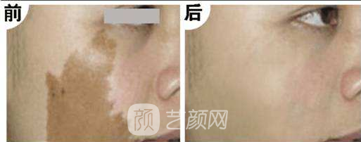 湖南激光祛斑好嗎？