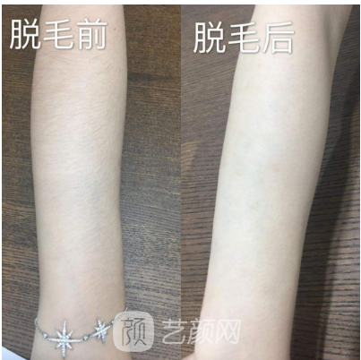 南昌紅蘋果做脫毛怎么樣?我們用實際情況來說話