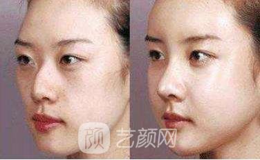 華人醫(yī)聯(lián)整形做駝峰鼻手術(shù)漂亮鼻形美麗無限