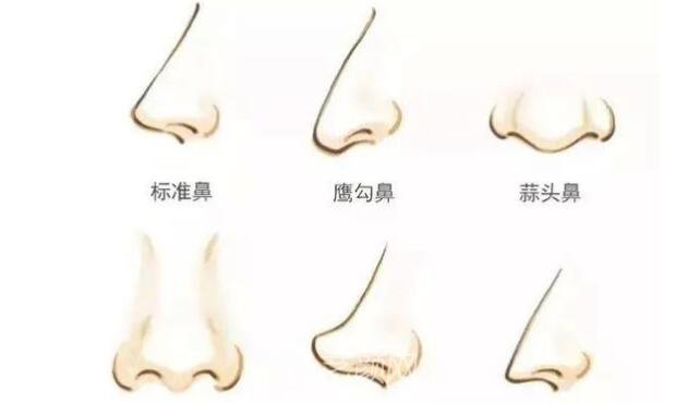 華人醫(yī)聯(lián)整形做駝峰鼻手術(shù)漂亮鼻形美麗無限