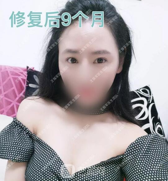 術(shù)后9個(gè)月果圖