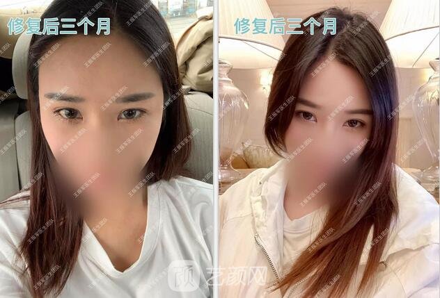 修復術(shù)后三個月果圖