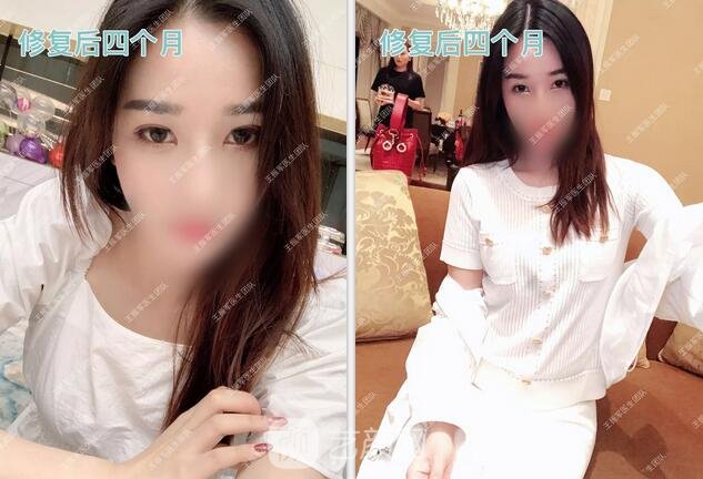 修復術(shù)后四個月果圖