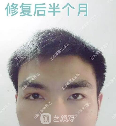 術后半個月果