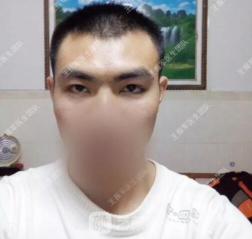眼部整形手術