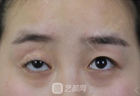 上瞼下垂如果不重視雙眼皮做了也白做！