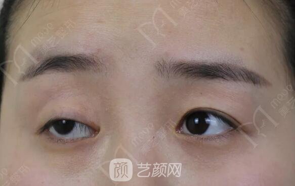 上瞼下垂如果不重視雙眼皮做了也白做！