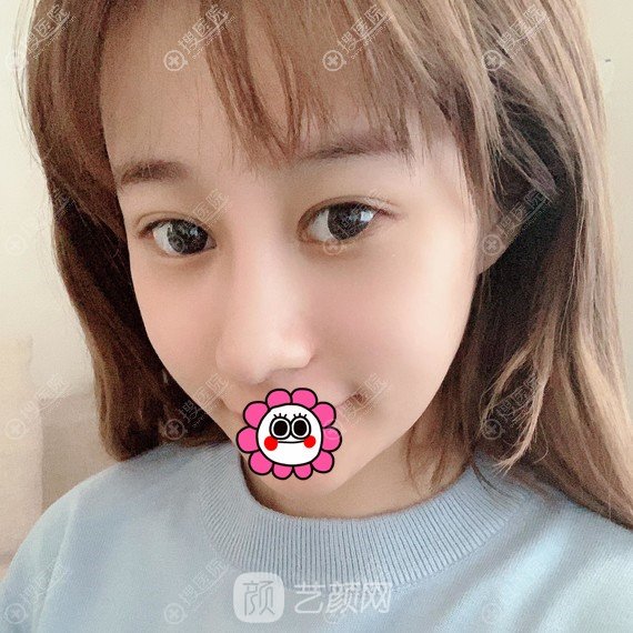 北京畫美于智宏自體肋軟骨隆鼻案例