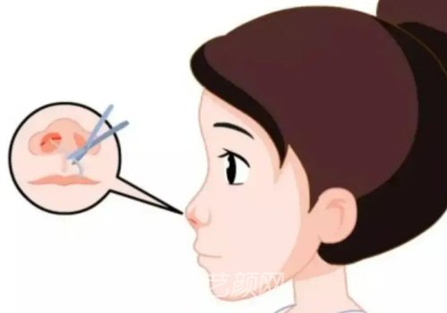 協(xié)和隆鼻多少錢?注射類