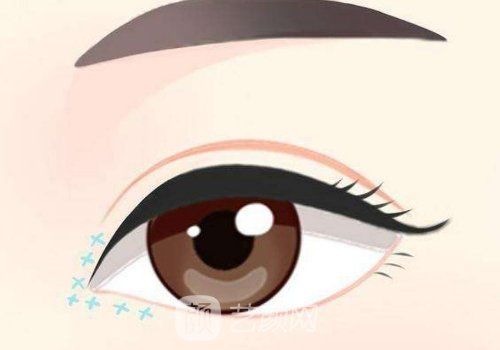 長春中妍整形醫(yī)院做雙眼